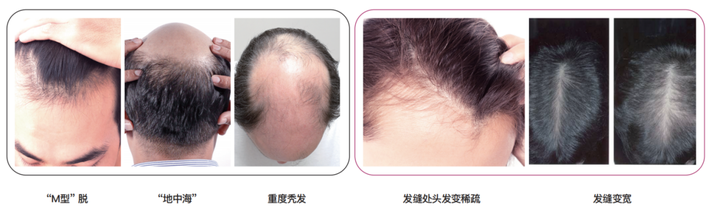 脂溢性脱发生发酊有用吗_脂溢性脱发怎么生发能长回来吗_脂溢性脱发的生发方法