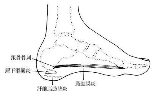 足跟痛是怎么回事？怎么治疗最有效的治疗方法